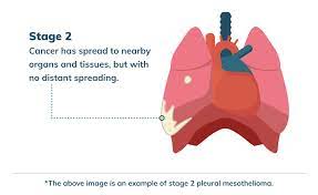 Stage 2 Mesothelioma Life Expectancy