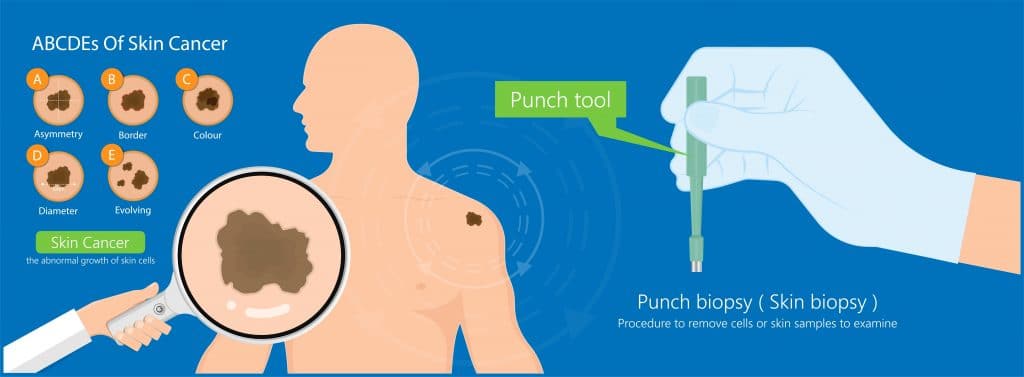 When Should I Get Skin Cancer Screening At A Skin Check Clinic?